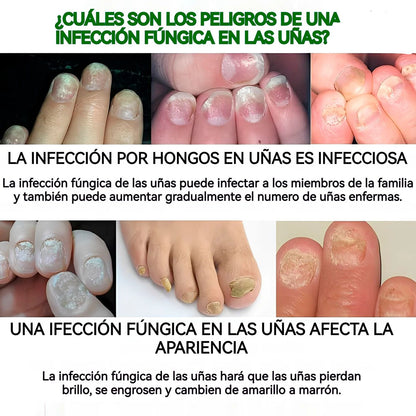 ✨Jaysuing 7 Days Serum: Despídete de los hongos y luce uñas perfectas 💅